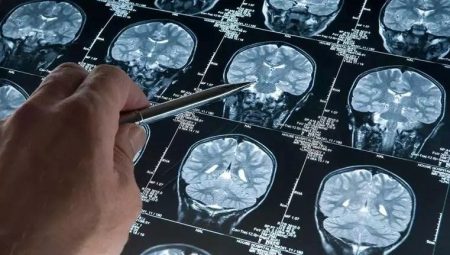 Bilim dünyası şokta: En genç Alzheimer olayı teşhis edildi